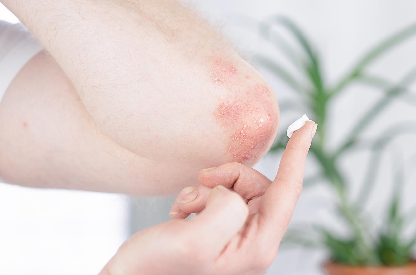 L’eczéma, peut-on l’éviter ? Comment le traiter ?