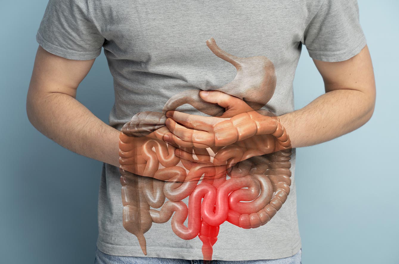 Cancer colorectal ou cancer de l’intestin