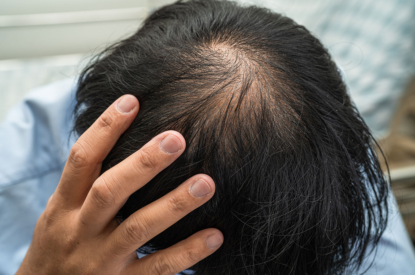 chute-cheveux-hommes-calvitie
