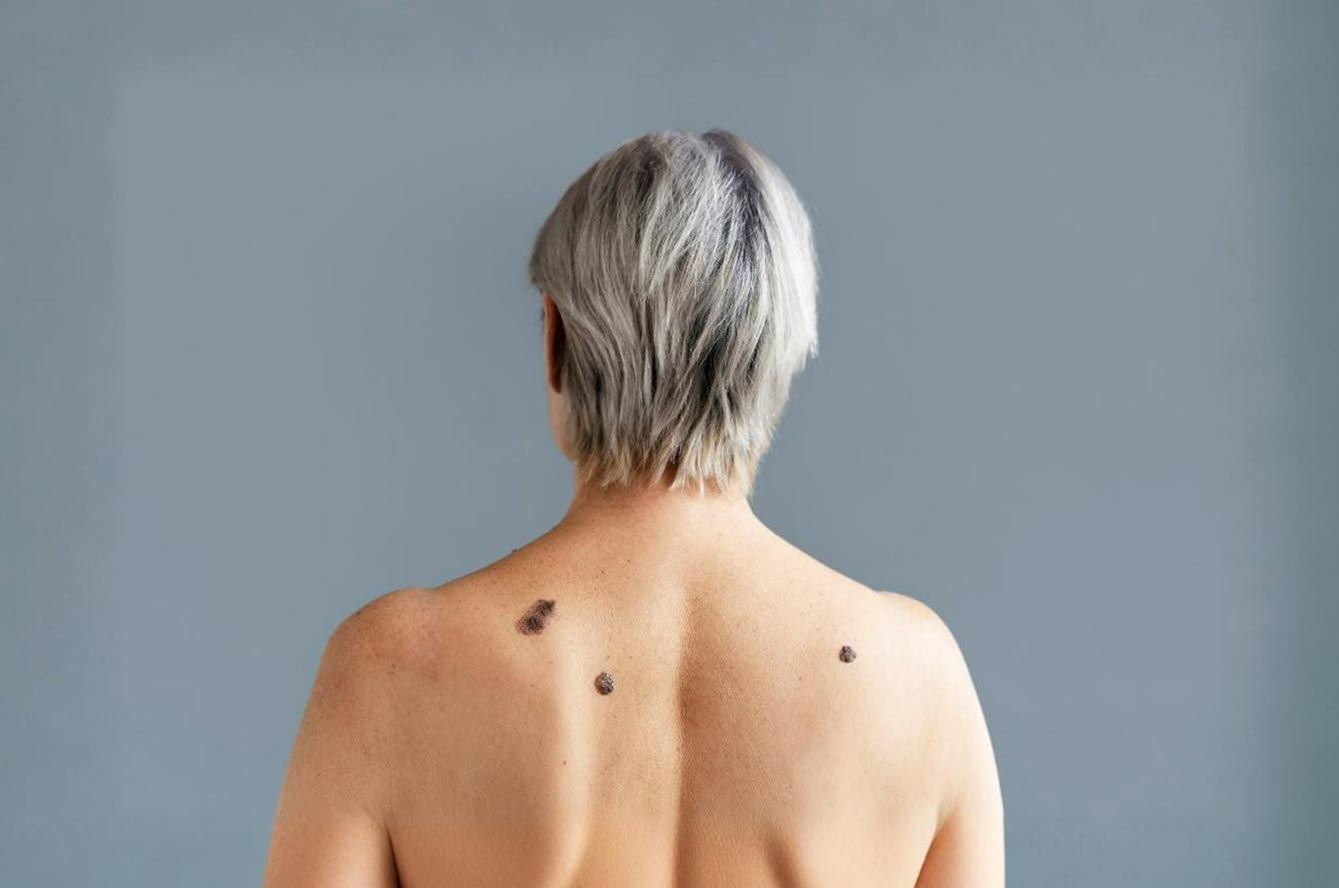 grains beauté surveiller cancer peau