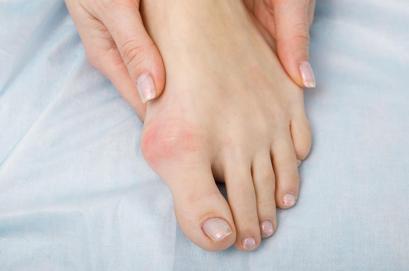 Qu'est-ce que l'hallux valgus ? Comprendre cette déformation du pied