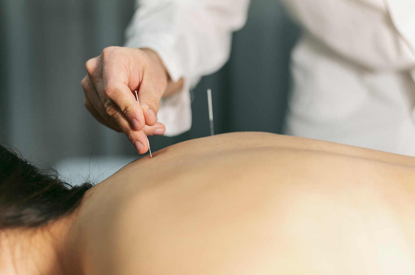 Acupuncture soulagez vos douleurs et améliorez votre bien-être