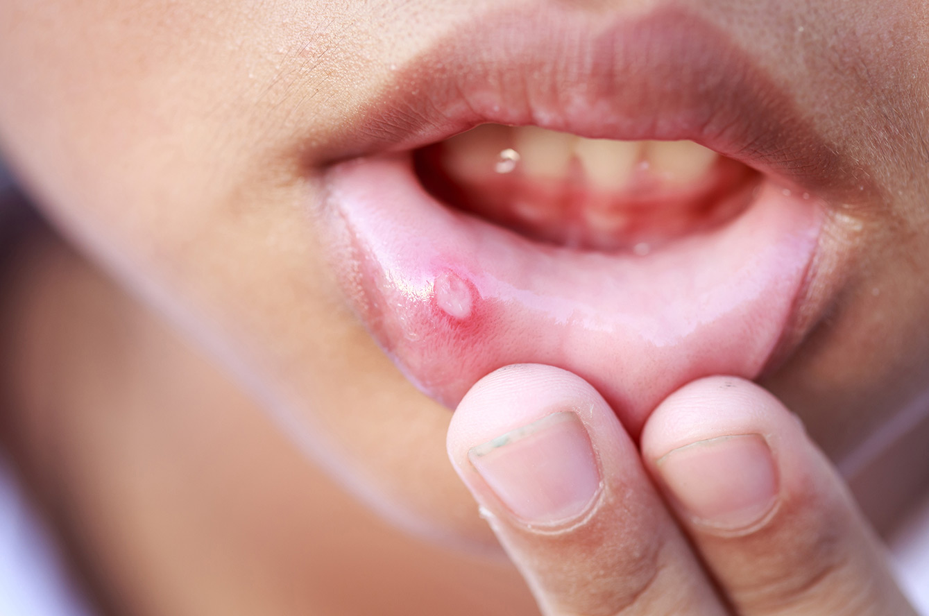 elfbar nachfüll pod läuft aus ELGYDIUM Clinic Cicalium - traitement aphte main image 0