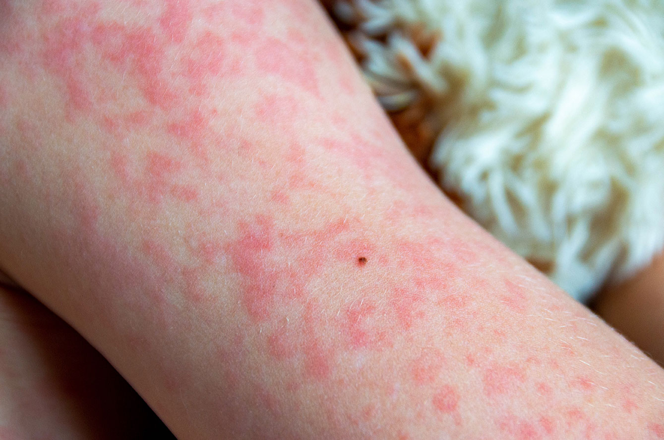 Rugeole adulte vaccin