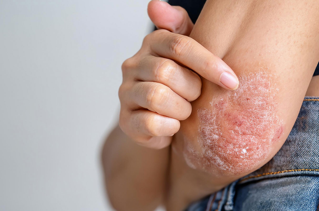 Traitement du psoriasis : comprendre, soigner et mieux vivre la maladie