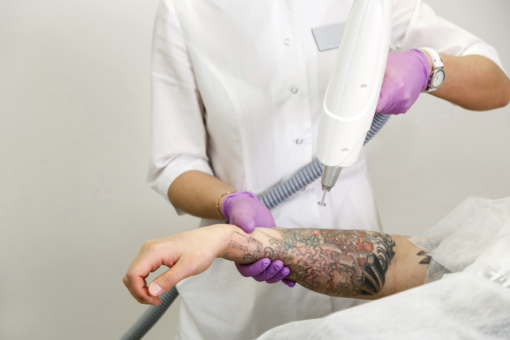 enlever un tatouage au laser