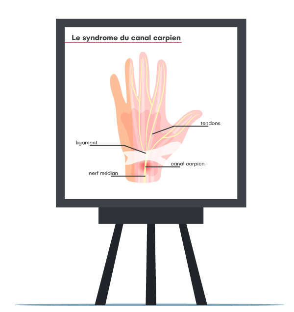 Comprendre le syndrome du canal carpien