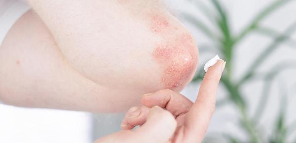 L'eczéma, peut-on l'éviter ? Comment le traiter ?