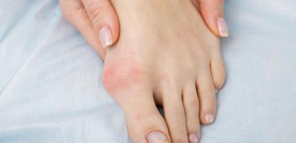Qu'est-ce que l'hallux valgus ? Comprendre cette déformation du pied