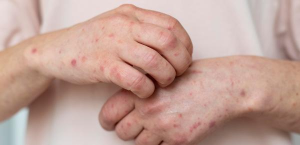 Monkeypox - variole du singe