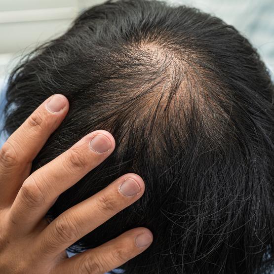 chute-cheveux-hommes-calvitie