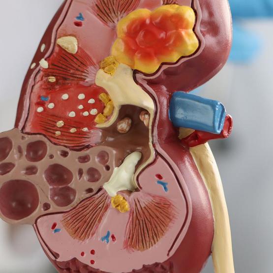 Prévenir et traiter la cystite : ce qu'il faut savoir