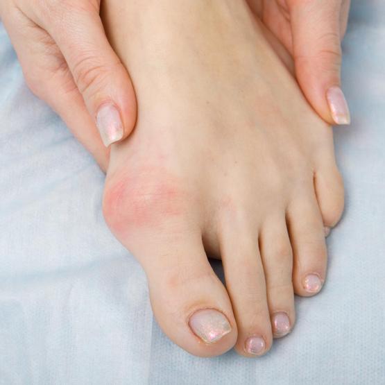 Qu'est-ce que l'hallux valgus ? Comprendre cette déformation du pied