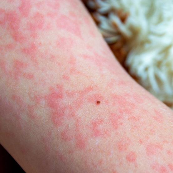 Rugeole adulte vaccin